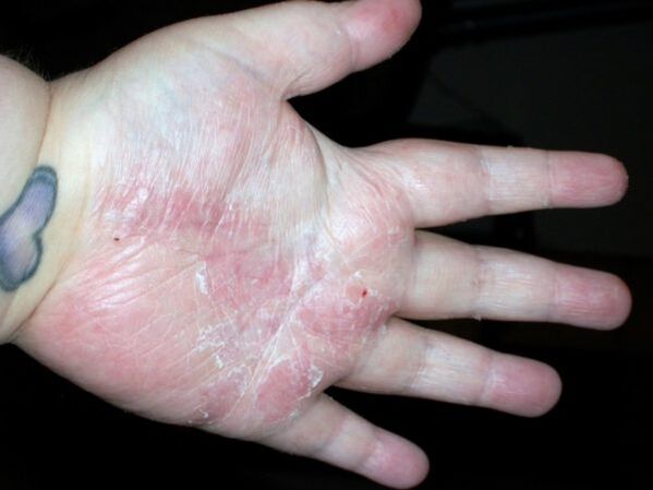 psoriasis op den Handflächen