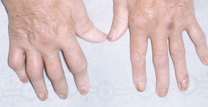 arthropathesch Psoriasis op den Hänn