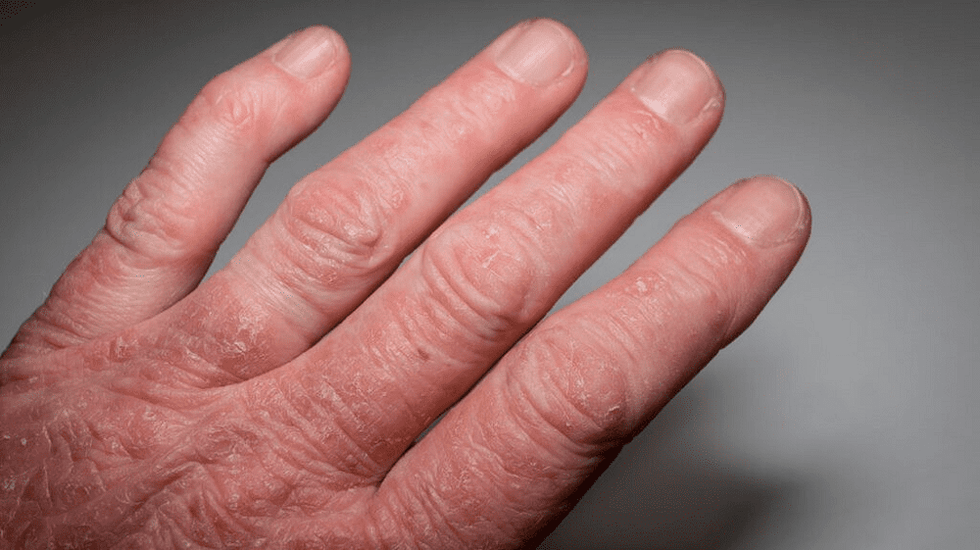 psoriatic Arthritis op den Hänn