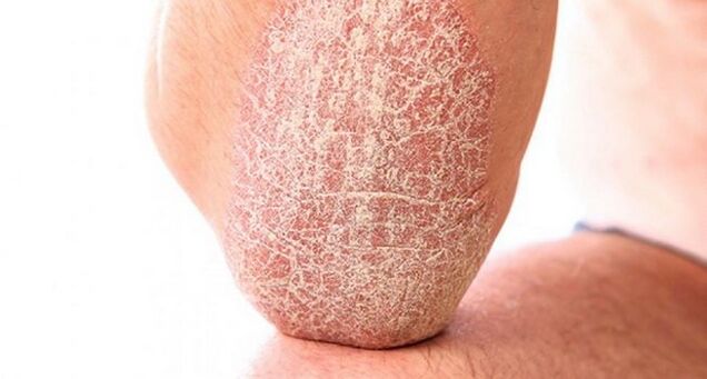 psoriasis vulgaris op der Haut