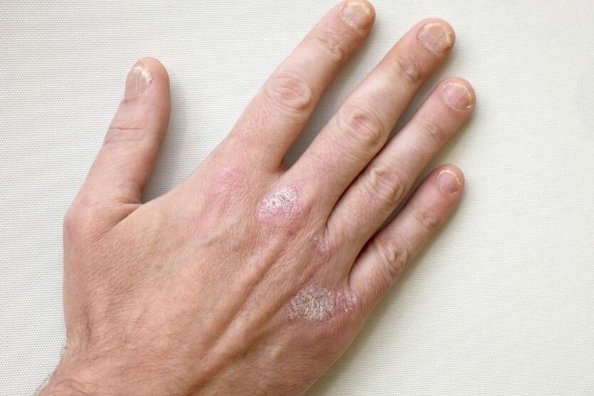 En obligatoresche Symptom vun der Psoriasis ass Plaques mat Skalen op der Haut