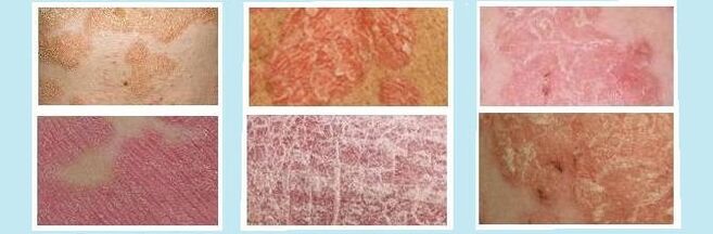 Hautausschlag charakteristesch fir verschidden Aarte vu Psoriasis