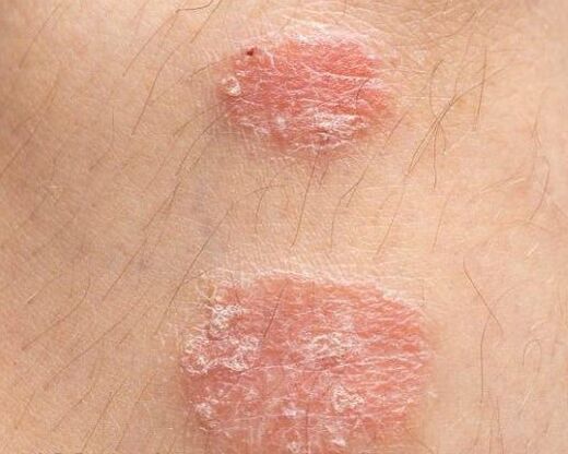 Erscheinung vun psoriiatesche Placke
