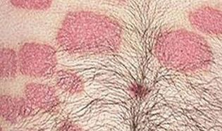 Multiple Pink Formatiounen um Bauch