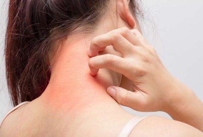 Jucken ass ee vun de Grënn vun der Psoriasis