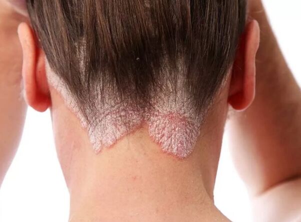 Psoriatic Errythroderma
