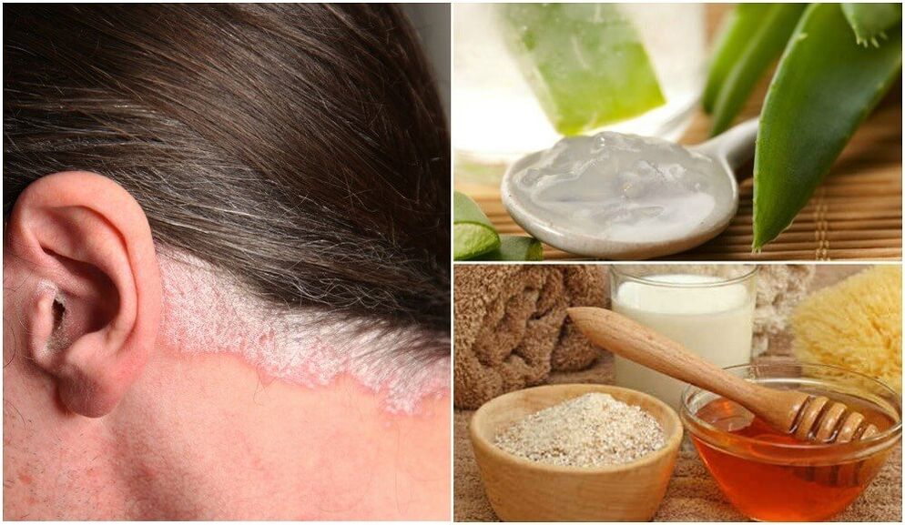 Behandlung vun der Psoriasis mat Folk Remedien