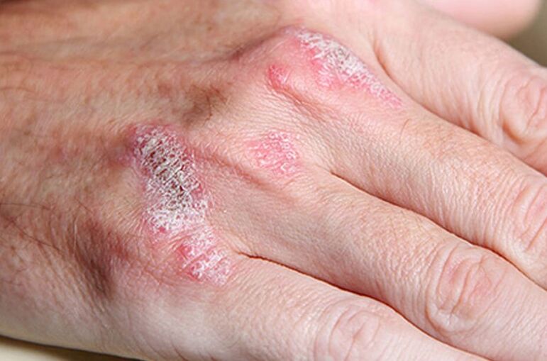 Laderary-nohaltegt Psoriasis