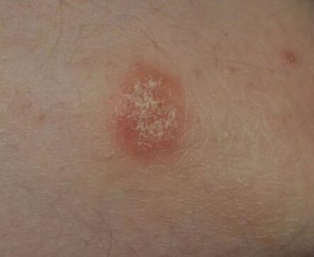 Psoriasis Plaz