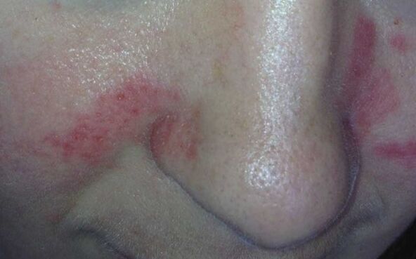 Symptomer vun der Psoriasis op d'Gesiicht