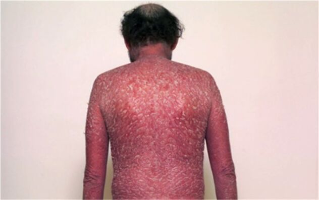 Déi drëtt Etapp vun der Psoriasis