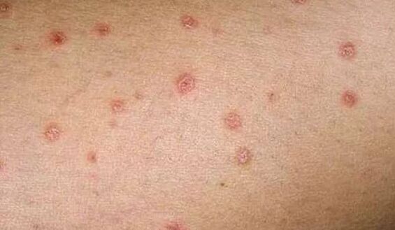 Déi initial Etapp vun der Psoriasis