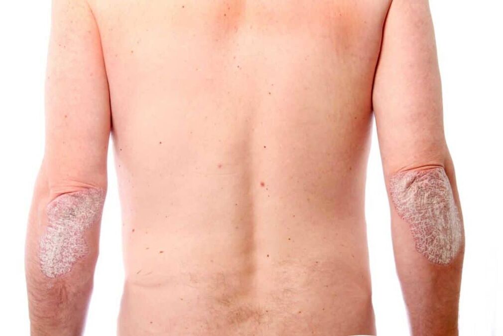 Déi zweet Etapp vun der Psoriasis