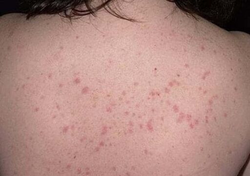 Déi initial Etapp vun der Psoriasis
