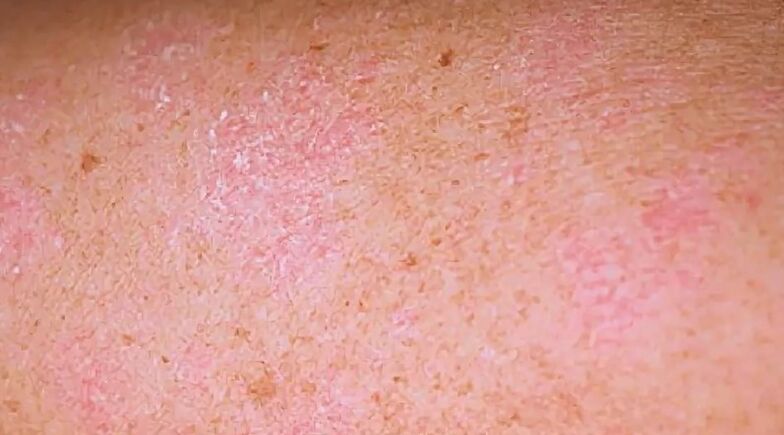 Déi regressiv Etapp vun der Psoriasis
