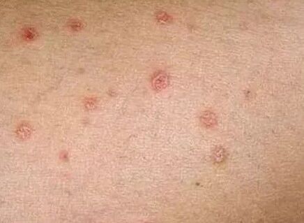 Psoriasis vun der éischter Etapp