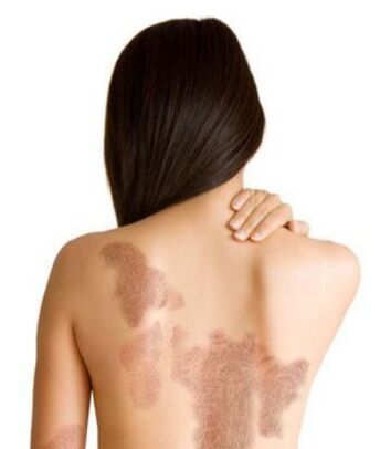 Stänn vun der Psoriasis ofhängeg vum Gebitt vun der Läsion