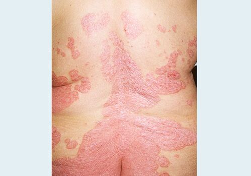 Psoriasis vum Réck