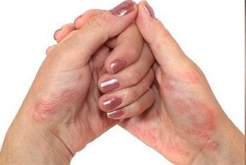 Psoriasis an den Hänn
