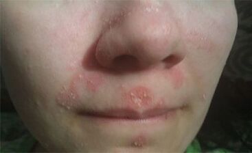 Psoriasis op d'Gesiicht