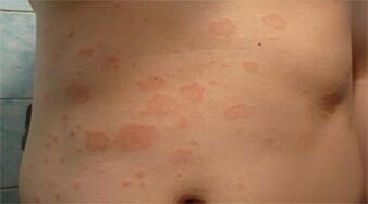 Psoriasis op de Bauch