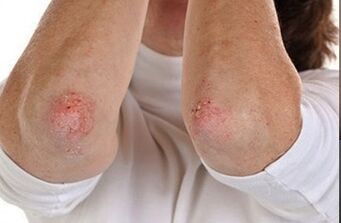 Psoriasis op den Ellbogen