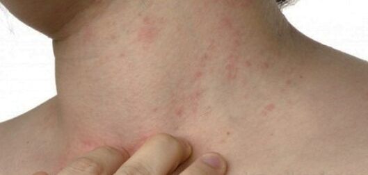 Psoriasis um Hals