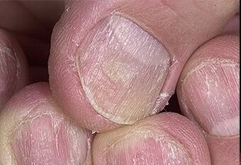 Psoriasis vun Neel