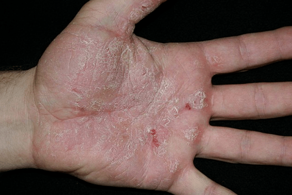 Psoriasis an den Hänn