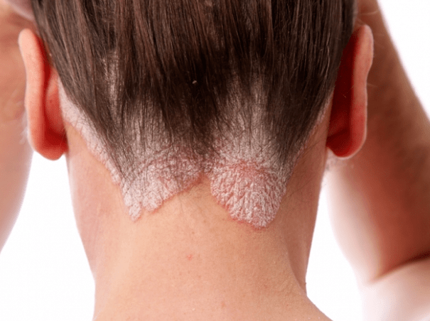 Psoriasis op de Kapp