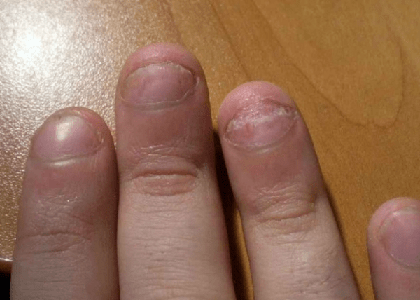 Psoriasis vun Neel