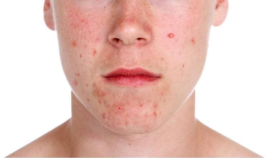 Psoriasis op d'Gesiicht