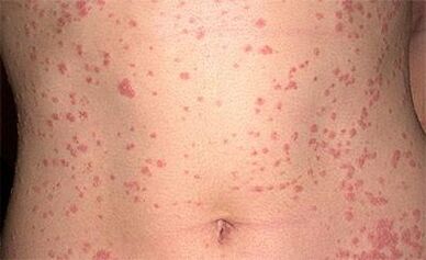 Psoriasis um Kierper