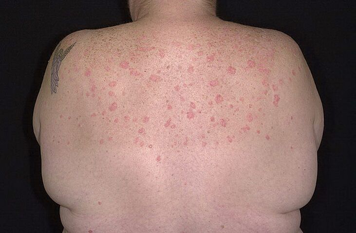 Psoriasis op d'Schëlleren