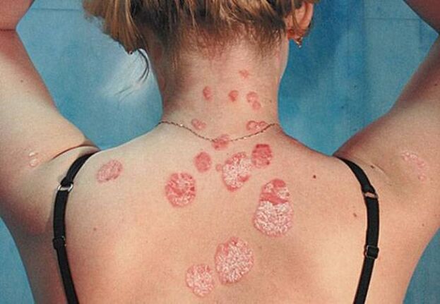 Psoriasis op der Réck