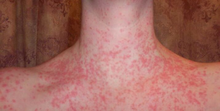 Psoriasis um Kierper