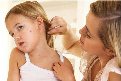 Foto vun der éischter Etapp vun der Psoriasis
