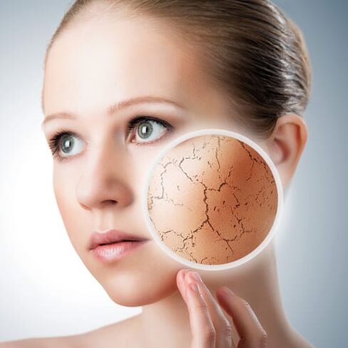 Psoriasis am Gesiicht