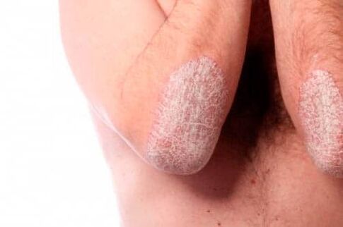 Psoriasis op den Ellbogen