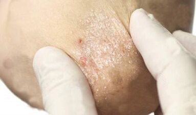 Behandlung vu Psoriasis an der Dämpfungsstadium