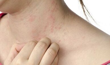 Behandlung vun Psoriasis an engem fortgeschrattene Stadium