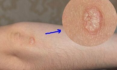 Etappe vun der Psoriasis Entwécklung