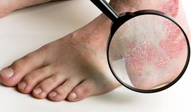 psoriasis Behandlung Optiounen