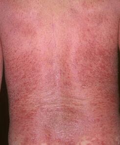Erythrodermie