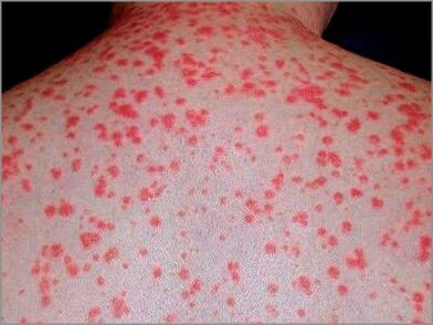 Gutt Psoriasis