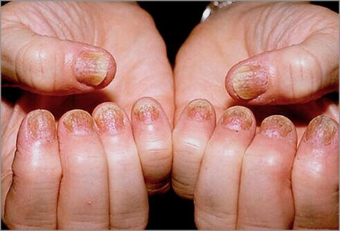 Nagel psoriasis