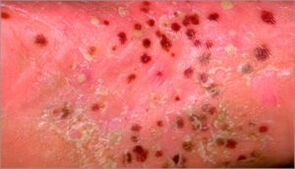 Pustulär Psoriasis