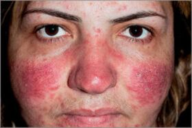 Seborrheesch Psoriasis