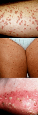 Psoriasis op de Been