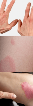 Psoriasis vun der initialer Etapp op den Hänn
